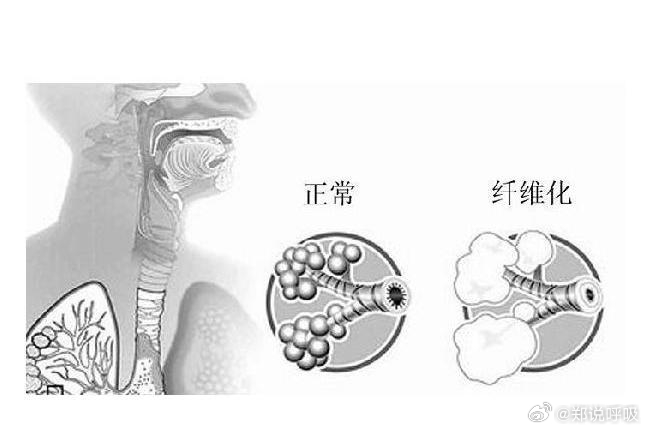 肺纤维化发病率呈上升趋势，专家呼吁重视肺纤维化早期干预